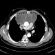 Thymoma, malignant thymoma: CT - Computed tomography